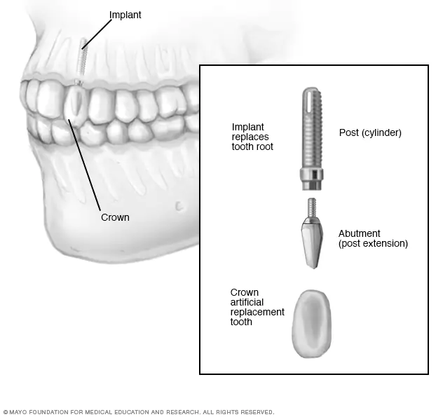 Dental Implants